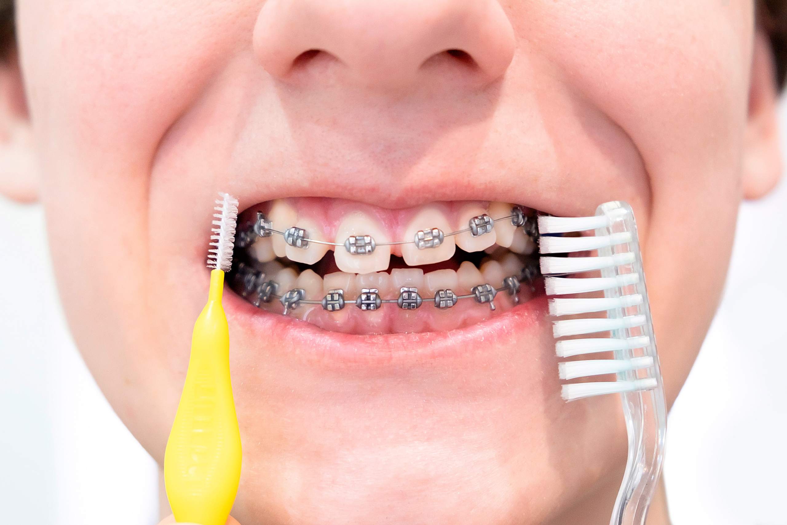 Problème orthodontie