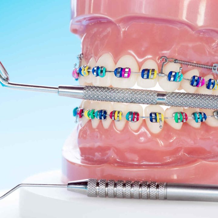 Broches boitiers orthodontiques